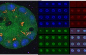 TUMORI AL SENO: SCOPERTI ALCUNI MECCANISMI DI PROLIFERAZIONE