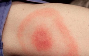 MALATTIA DI LYME: ATTENZIONE IN FVG