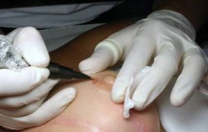 CRO AVIANO: ARRIVA LA DERMOPIGMENTAZIONE GRATUITA