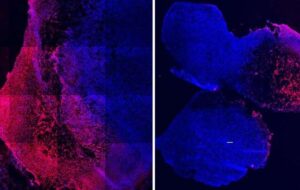 CANCRO AL SENO TRIPLO NEGATIVO,  SVOLTA NELLA RICERCA DI  UN VACCINO CELLULARE AUTOLOGO