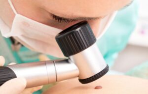 MELANOMA: CONTROLLARSI ANCHE IN ASSENZA DI SINTOMI