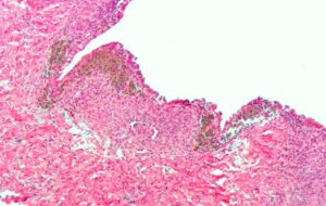 ENDOMETRIOSI, A UDINE IL PRIMO CONVEGNO NAZIONALE